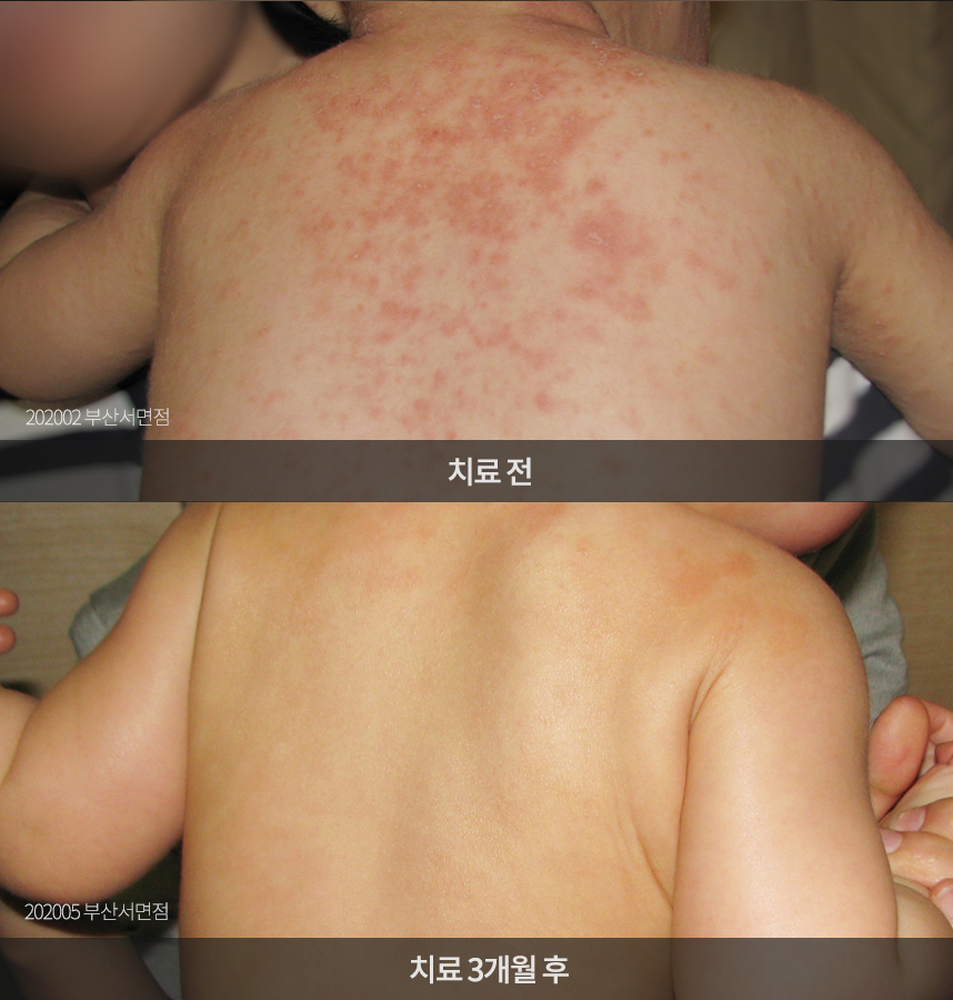 소아 아토피 치료 전후 사례