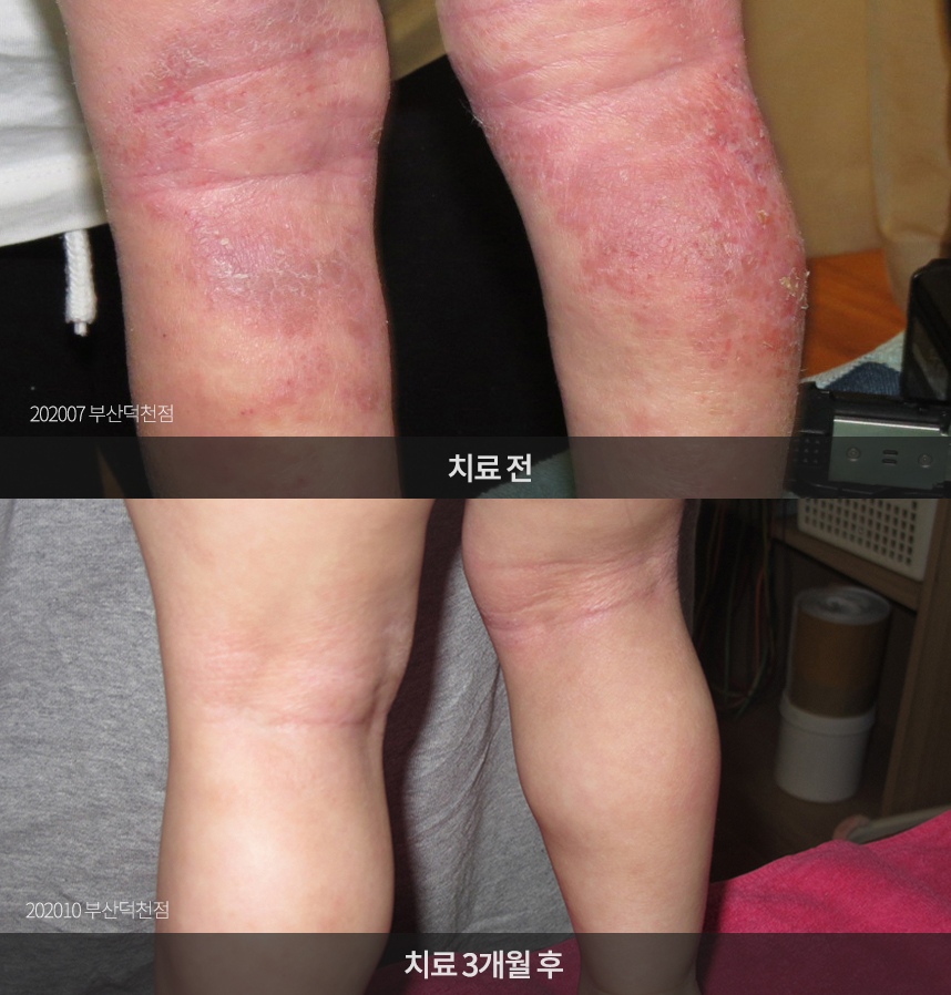 소아 아토피 치료 전후 사례