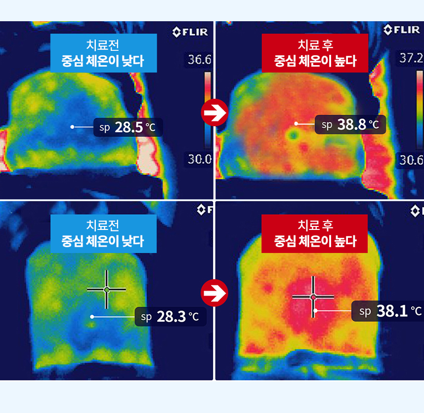 약물도포치료를 받는 여드름환자
