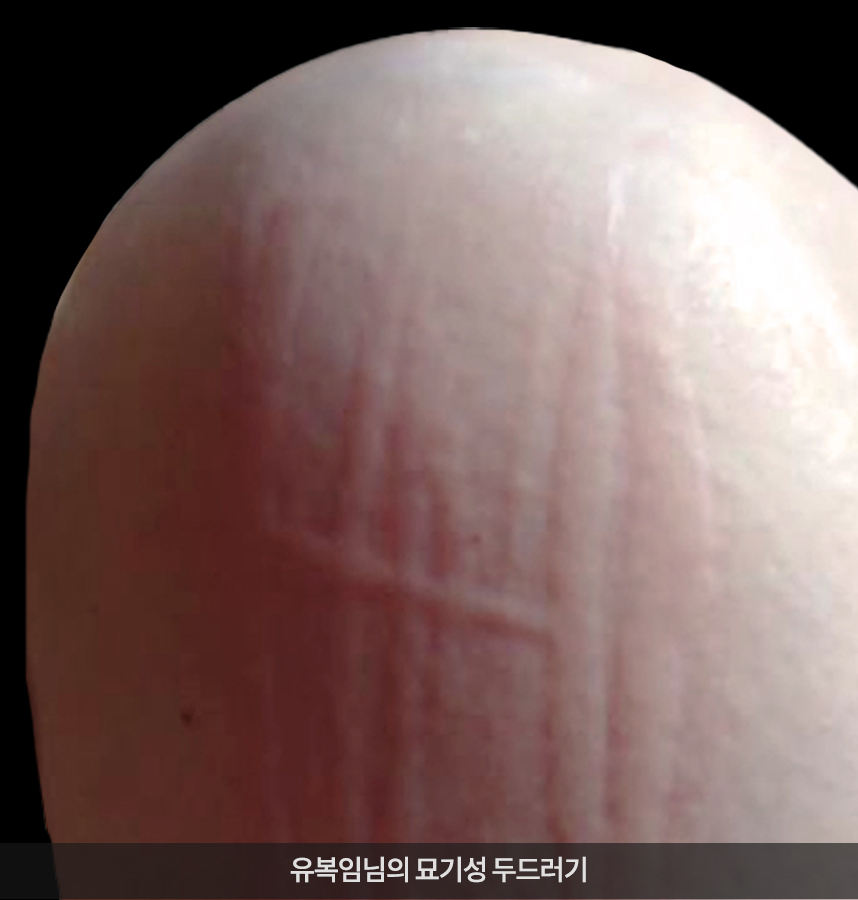 두드러기 치료 전 사진