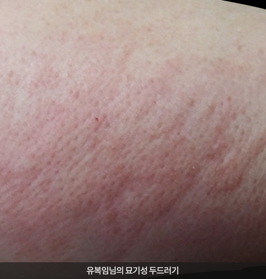두드러기 치료 전 사진