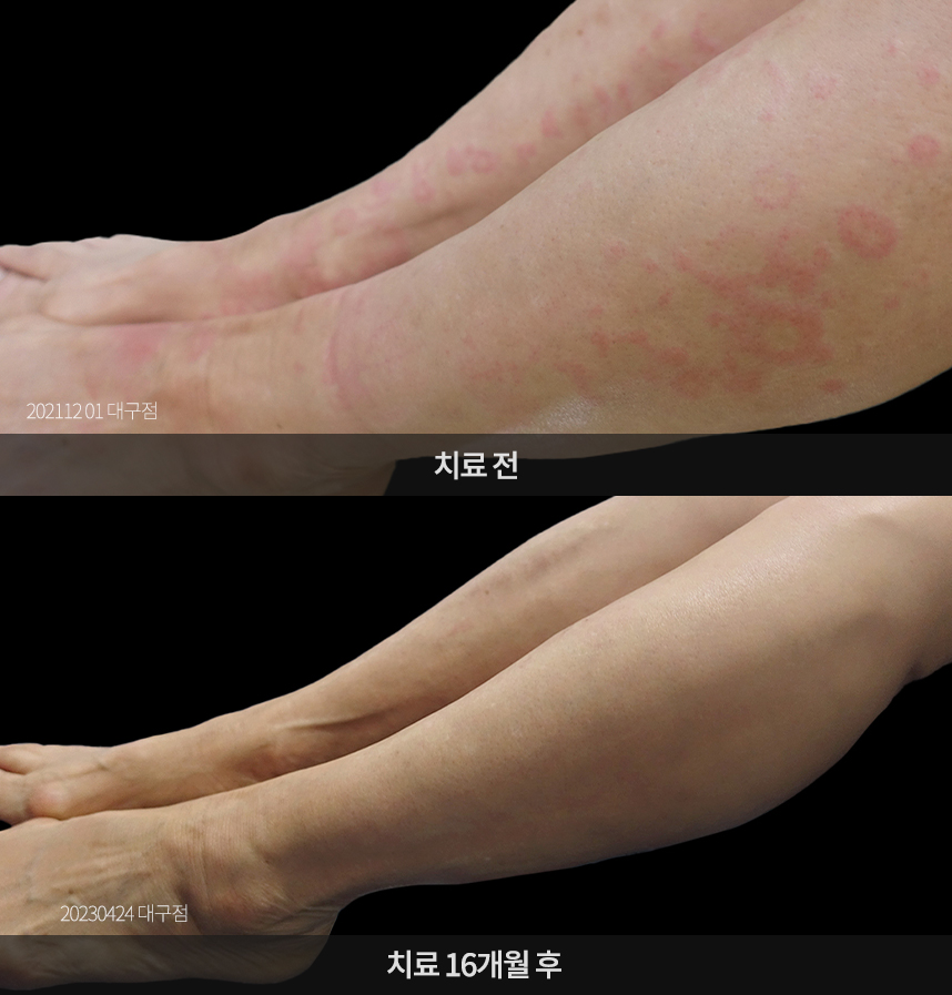 두드러기 치료 전후 사례