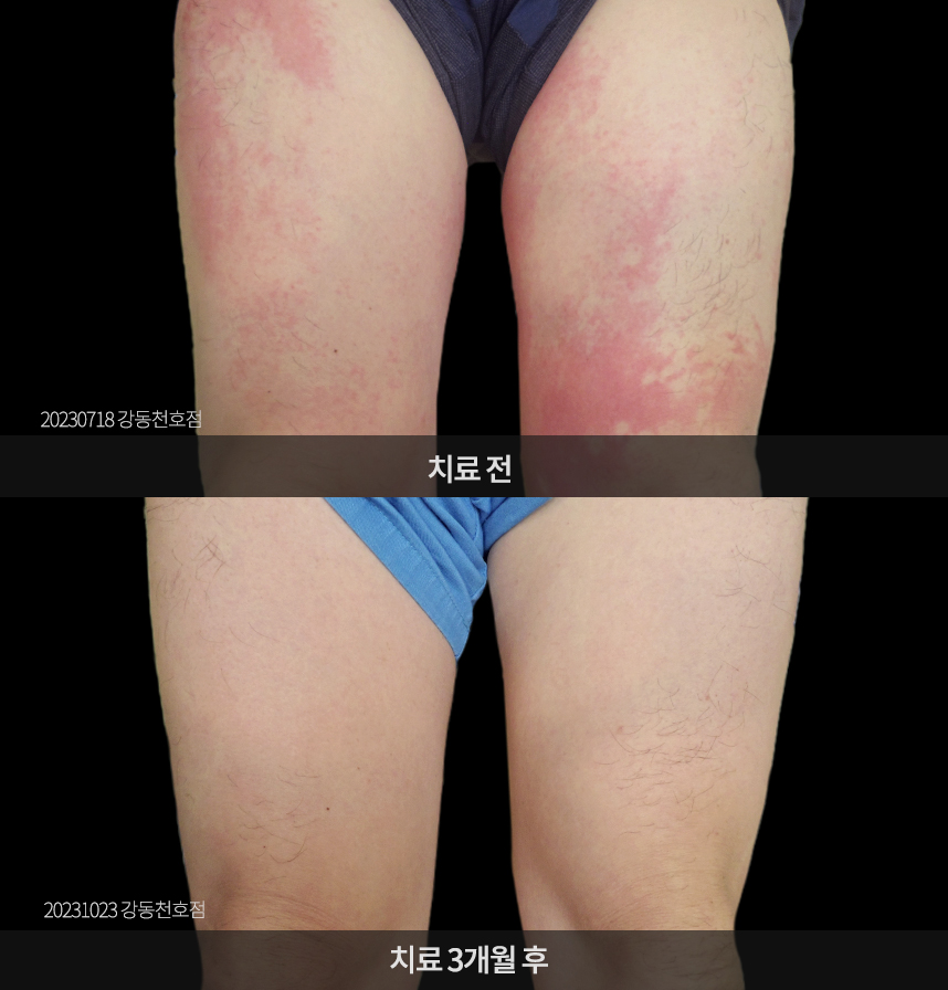 두드러기 치료 전후 사례