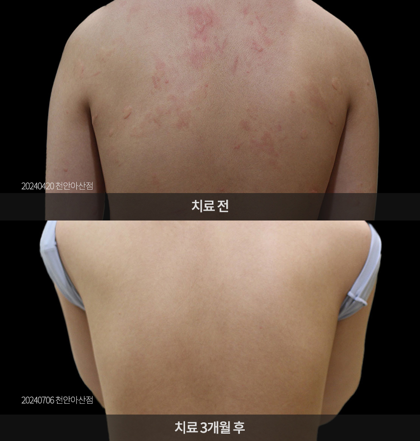 두드러기 치료 전후 사례