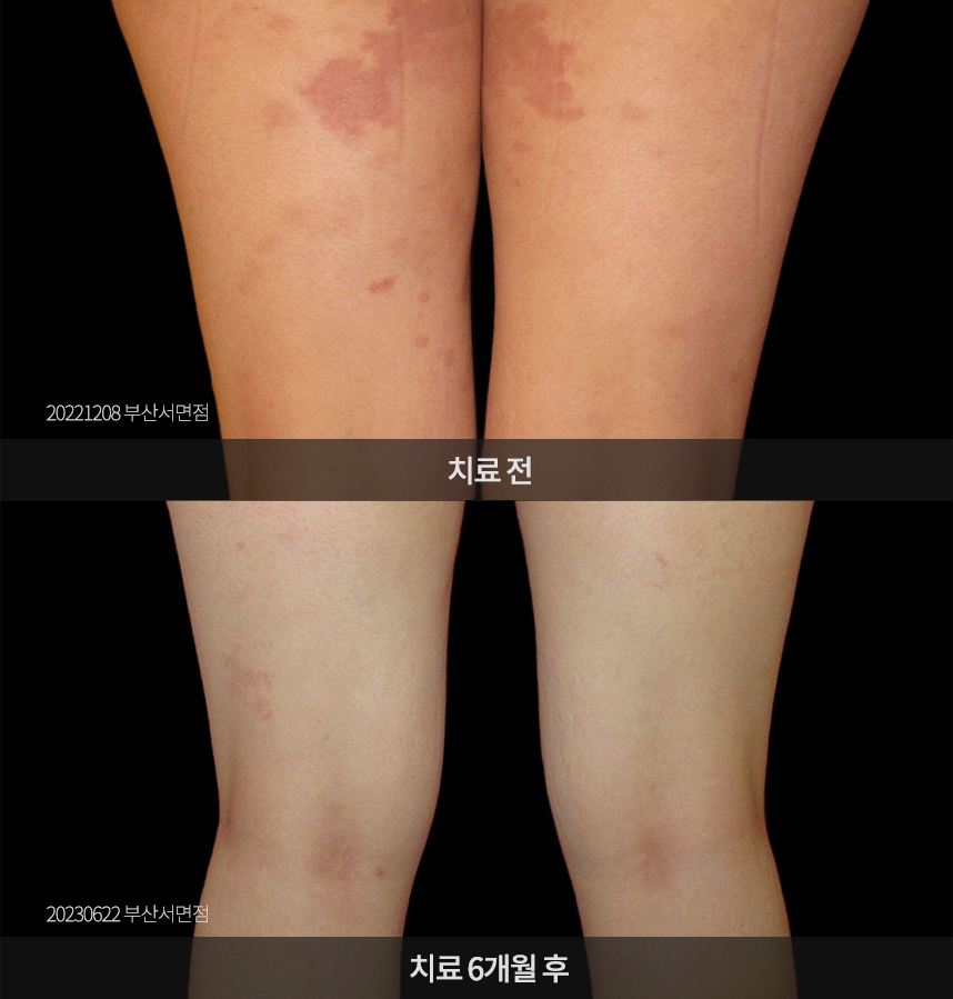 두드러기 치료 전후 사례
