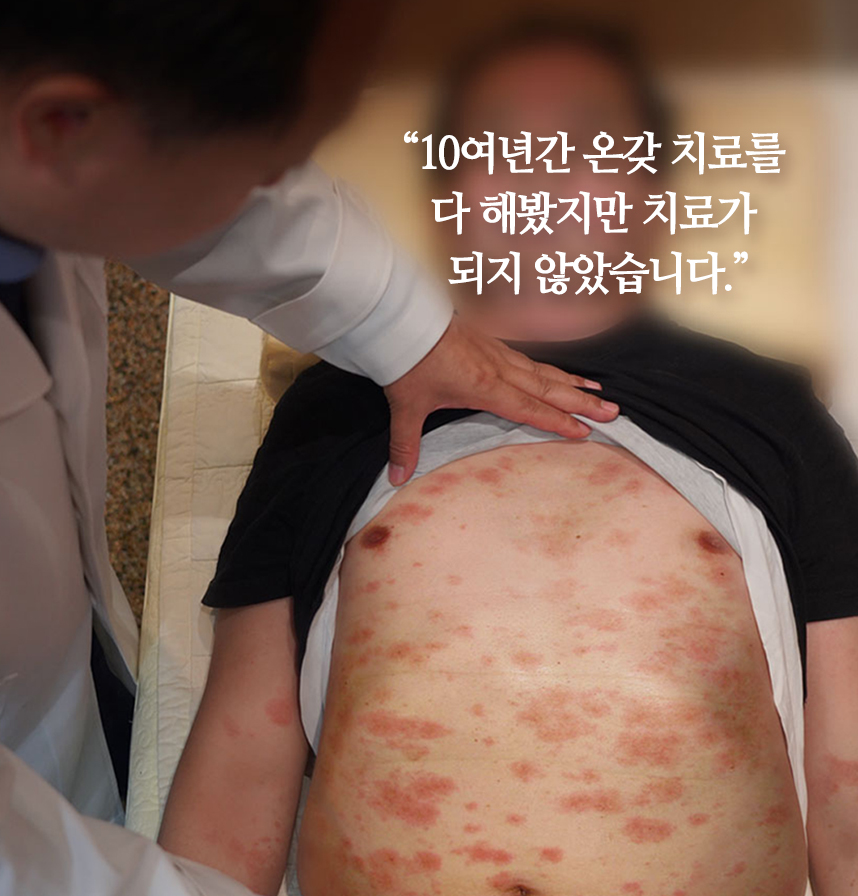 일본에서 온 온몸이 건선으로 뒤덮힌 환자