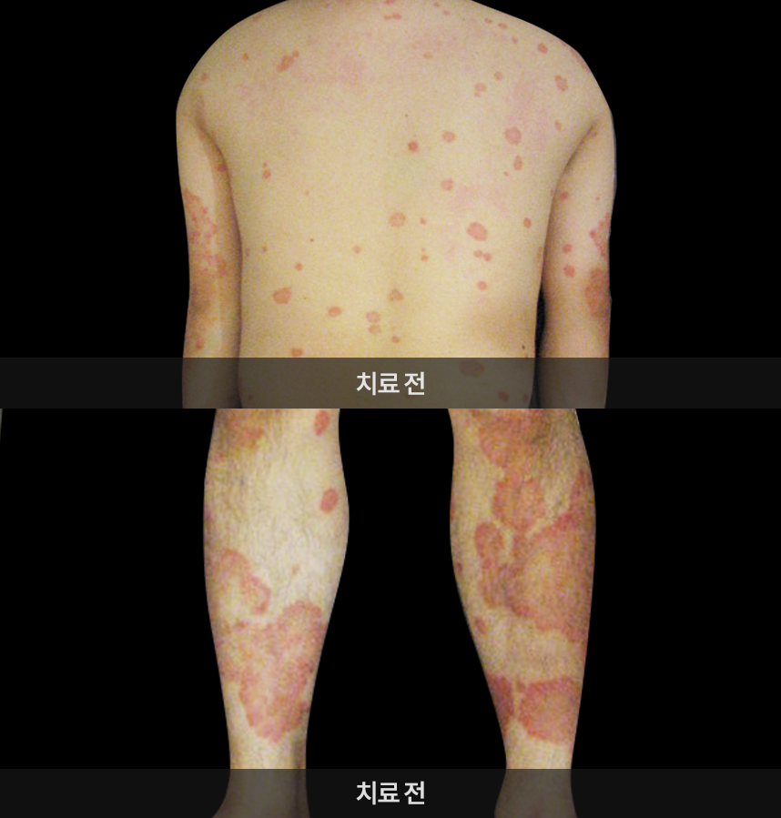 심영식씨 치료전