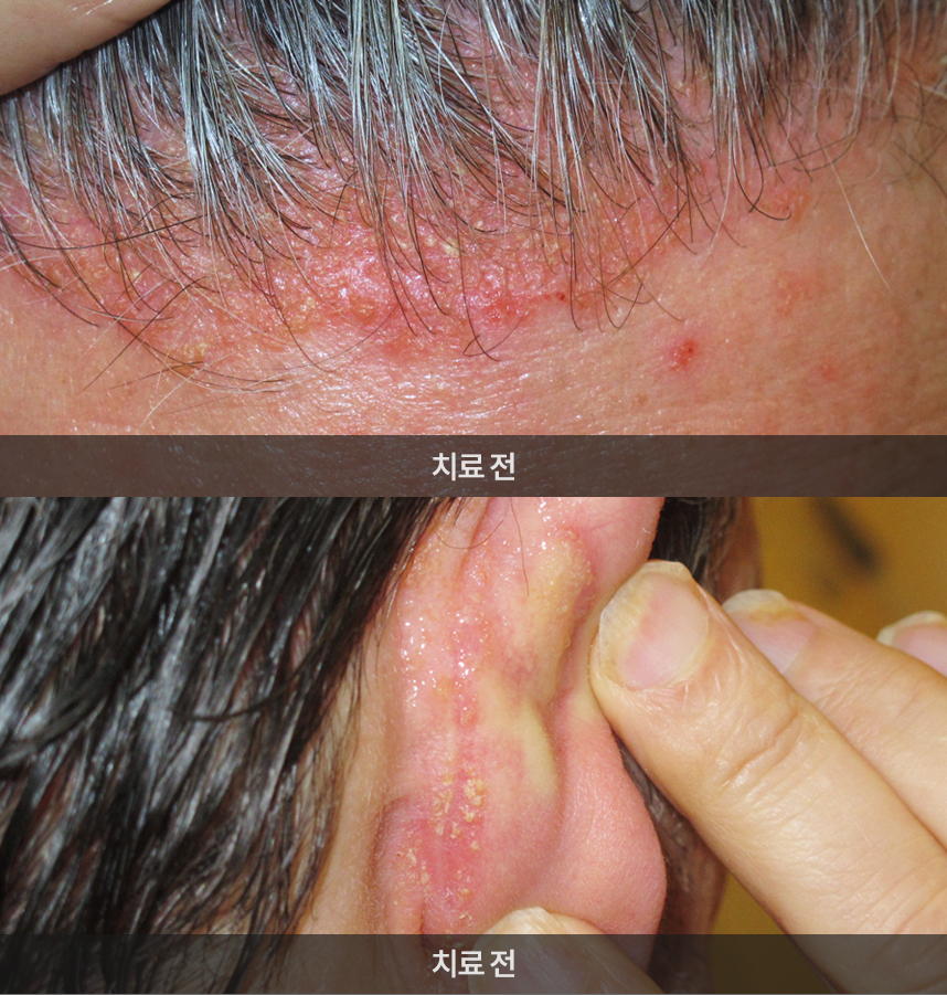 대니얼 세루야씨의 치료전