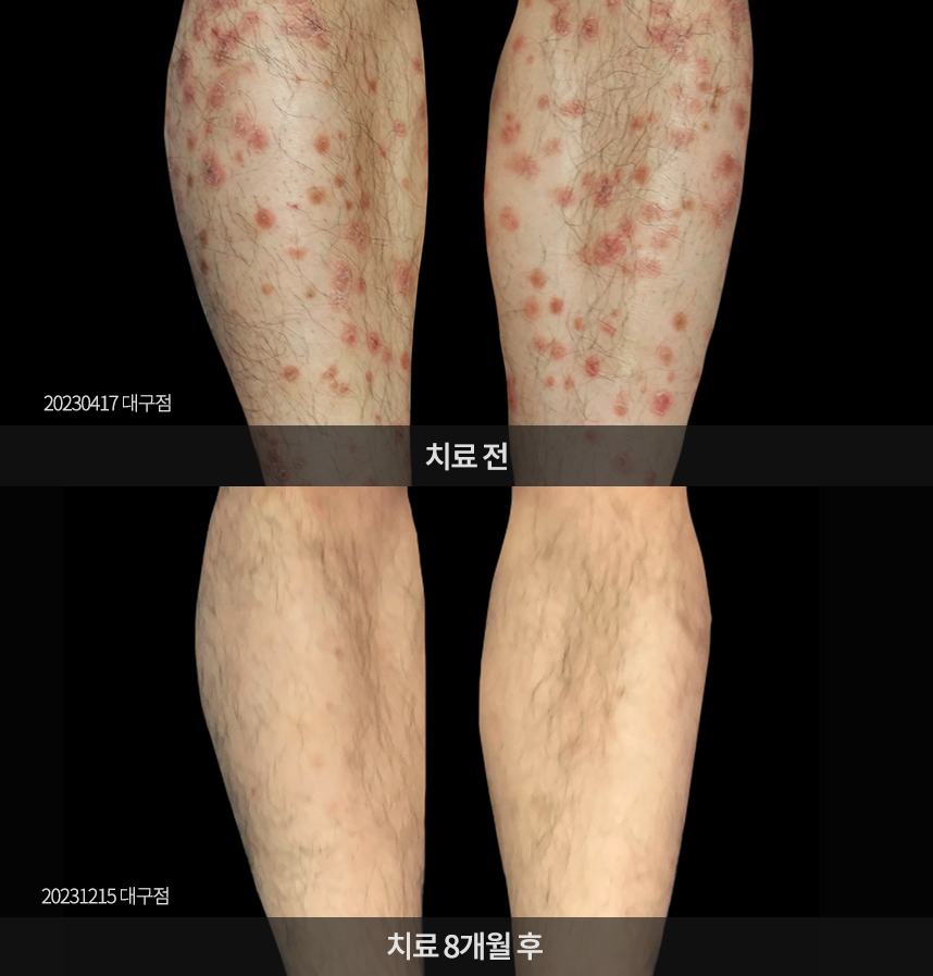 건선 치료 전후 사례