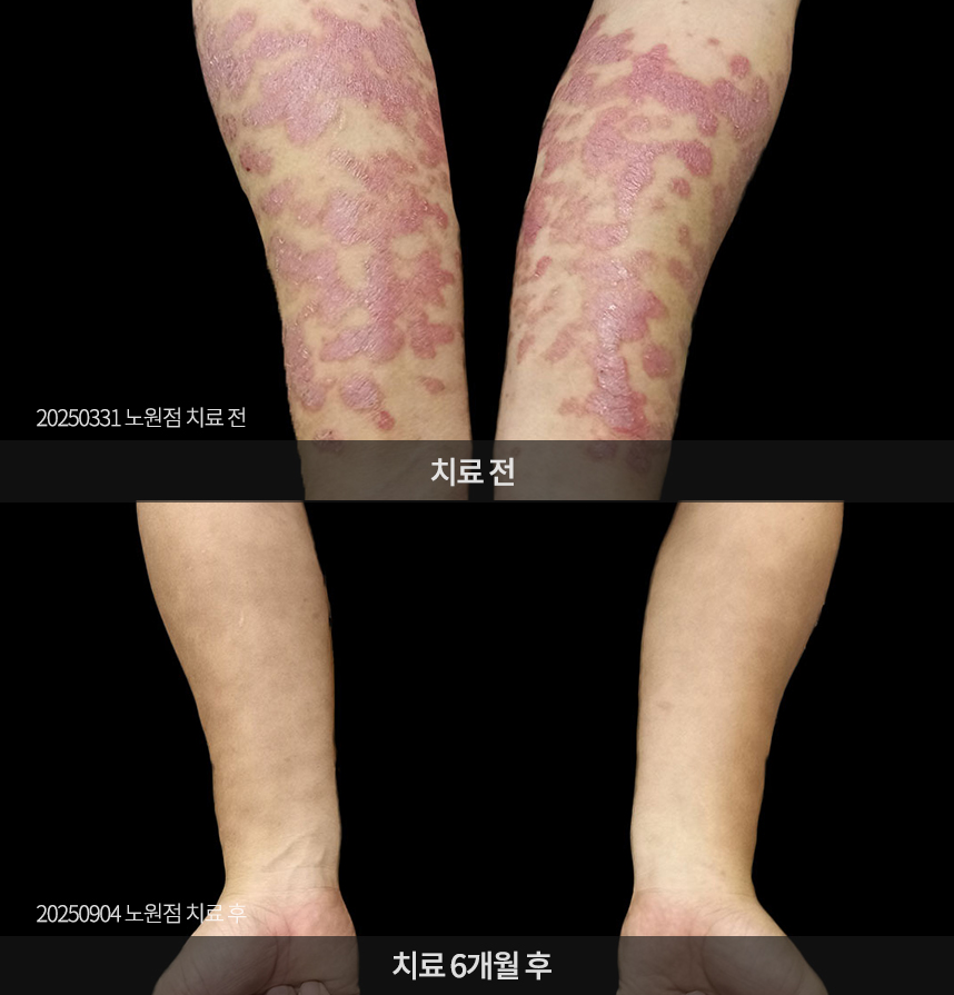 건선 치료 전후 사례