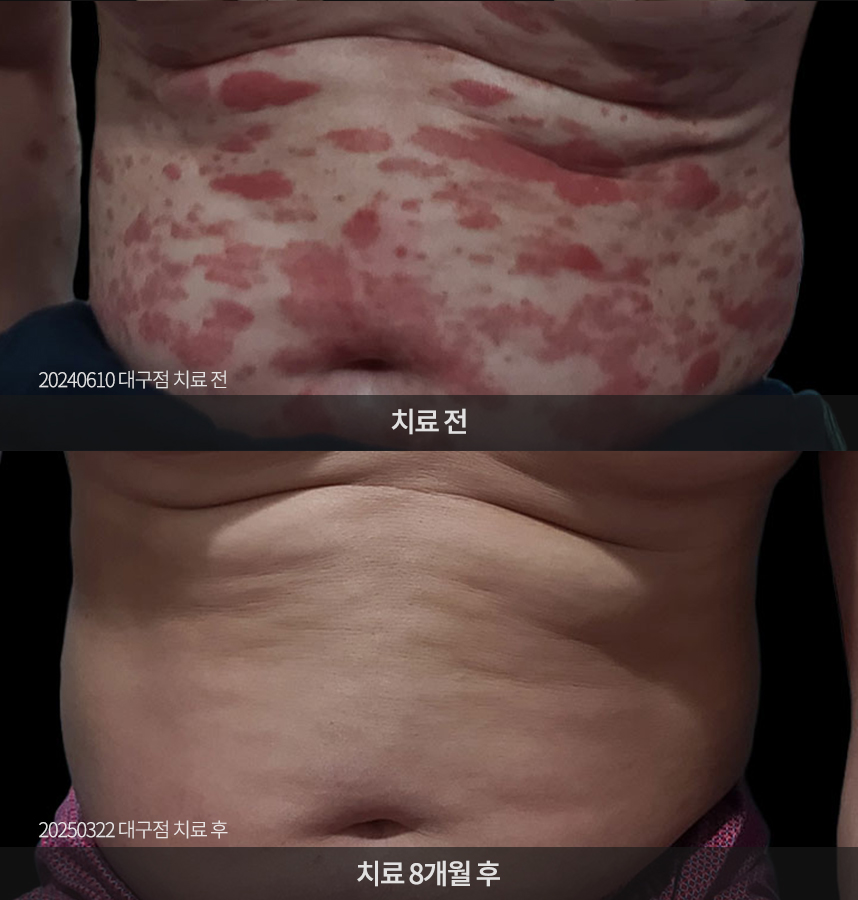 건선 치료 전후 사례