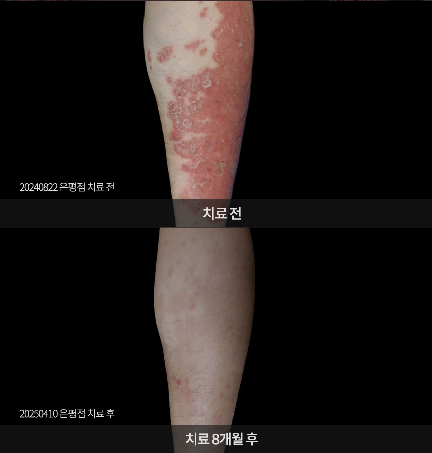 건선 치료 전후 사례