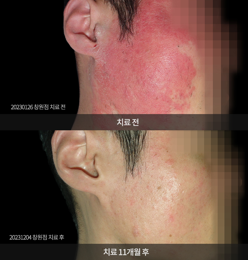 건선 치료 전후 사례