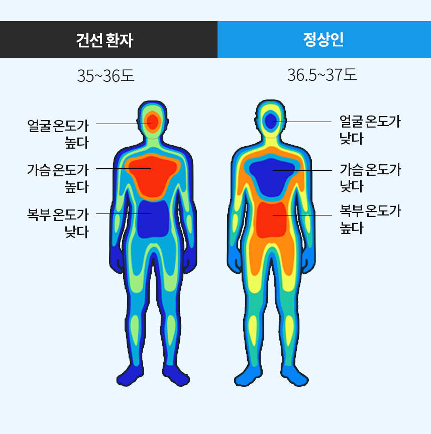 건선환자 체온