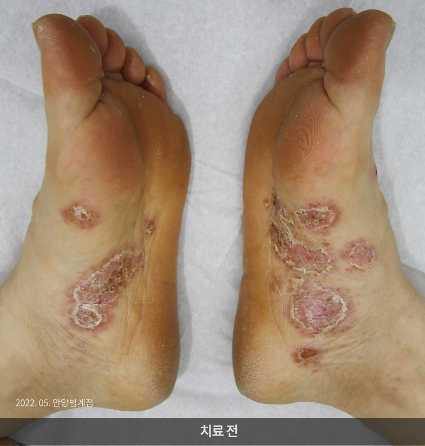 한포진 치료 전 사진