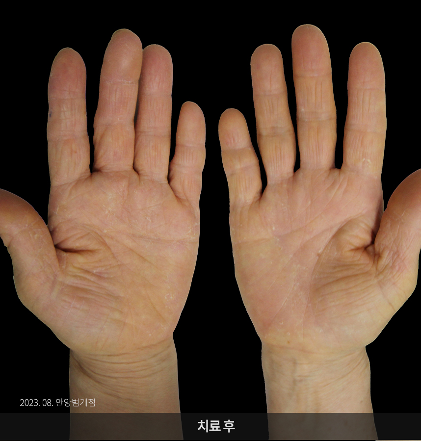 한포진 치료 후 사진