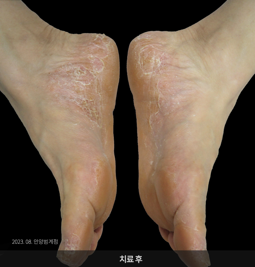 한포진 치료 후 사진