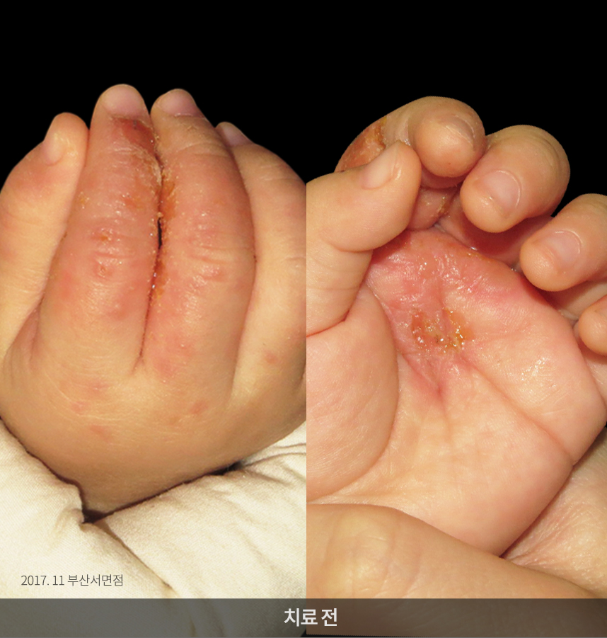 한포진 치료 전 사진