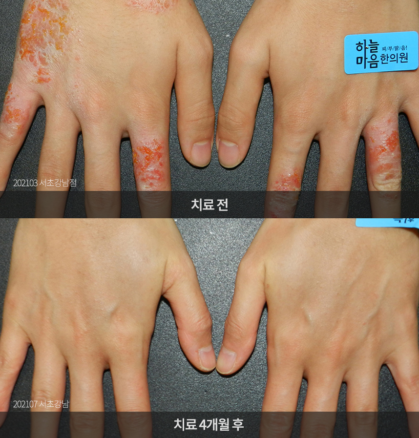 한포진 치료 전후 사례