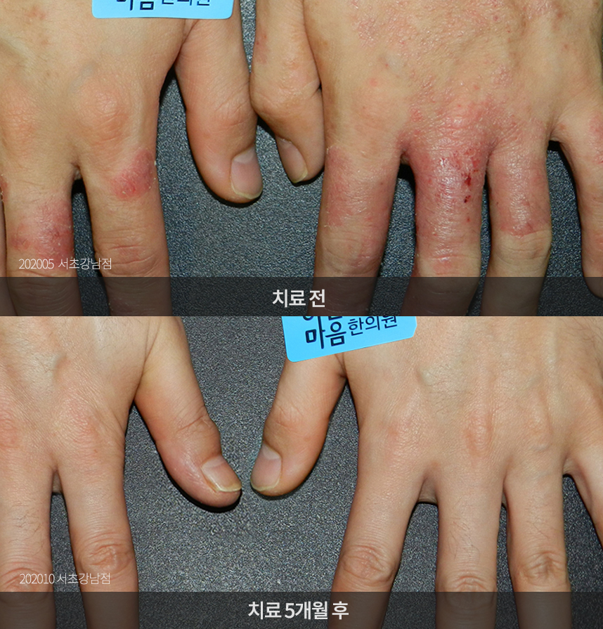 한포진 치료 전후 사례