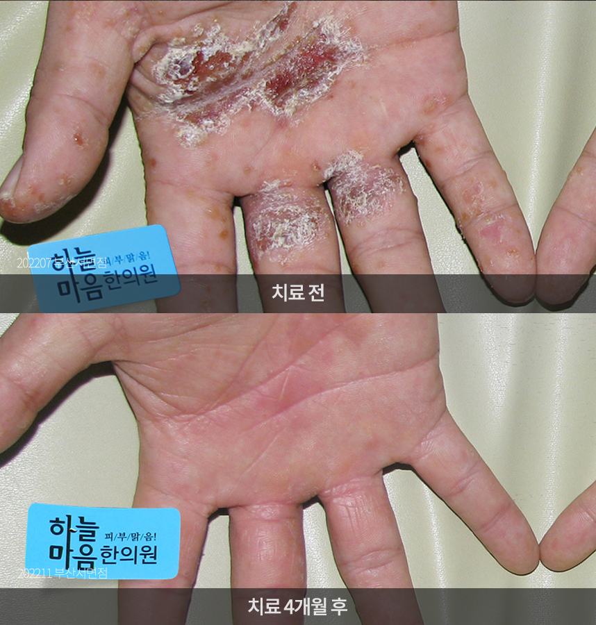 한포진 치료 전후 사례