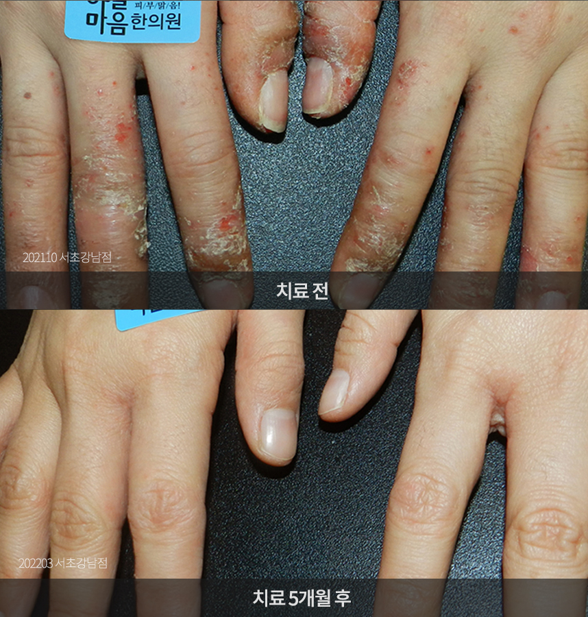 한포진 치료 전후 사례