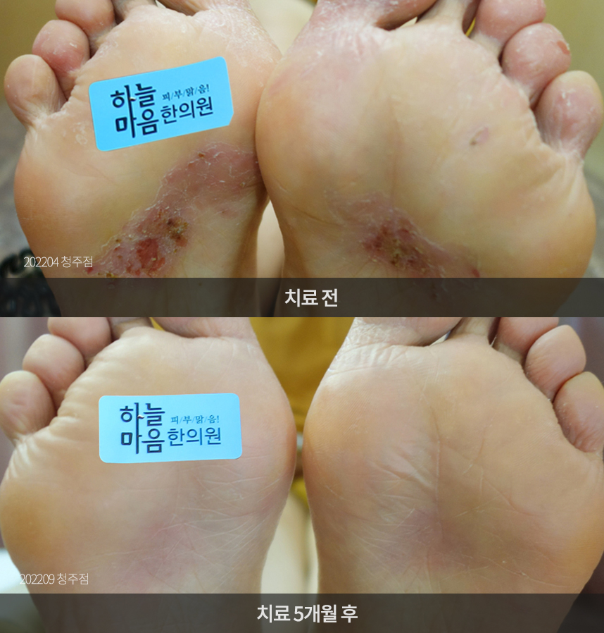 한포진 치료 전후 사례