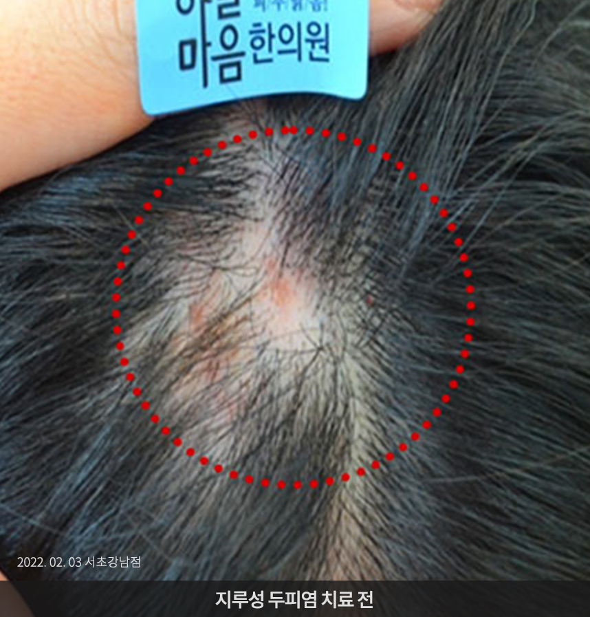 지루성두피염 치료 전 사진