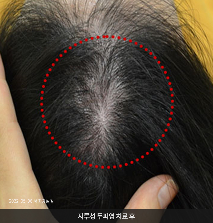 지루성두피염 치료 후 사진