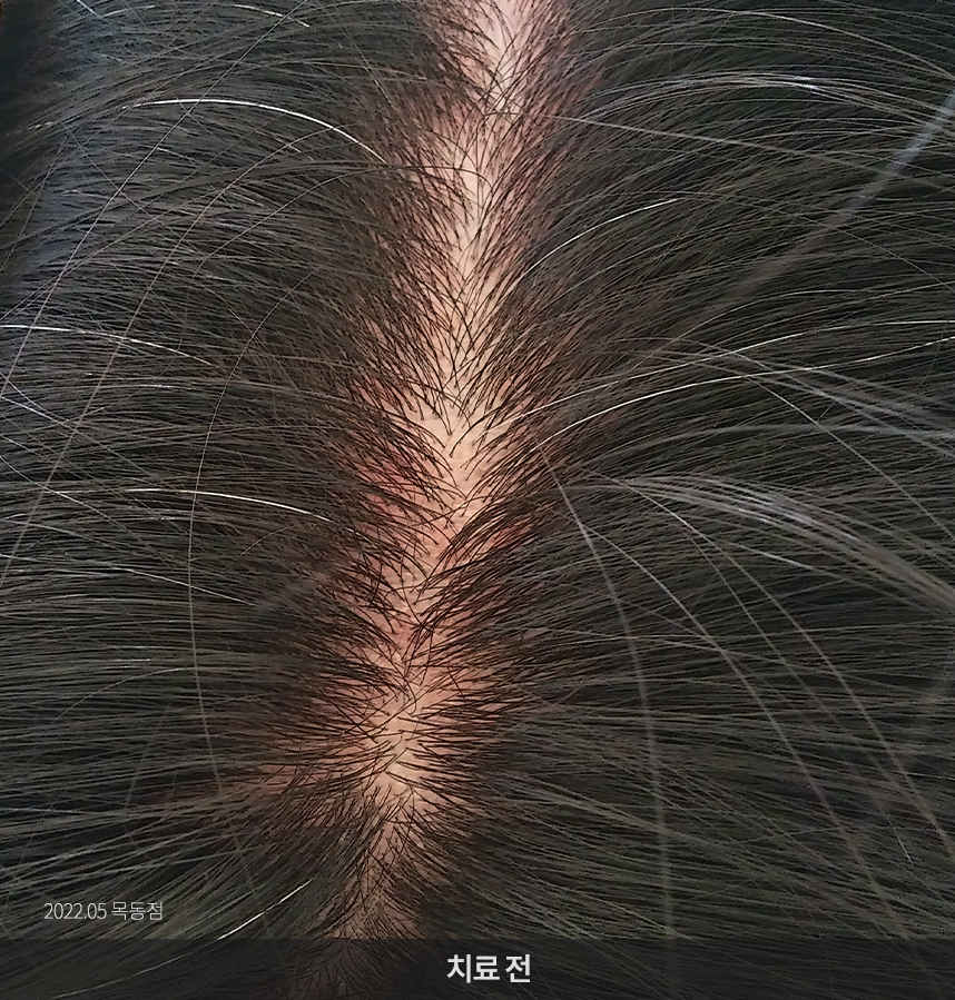 지루성두피염 치료전