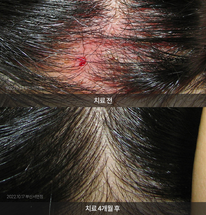 지루성두피염 치료 전후 사례