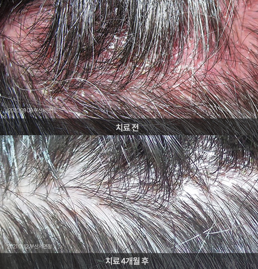 지루성두피염 치료 전후 사례