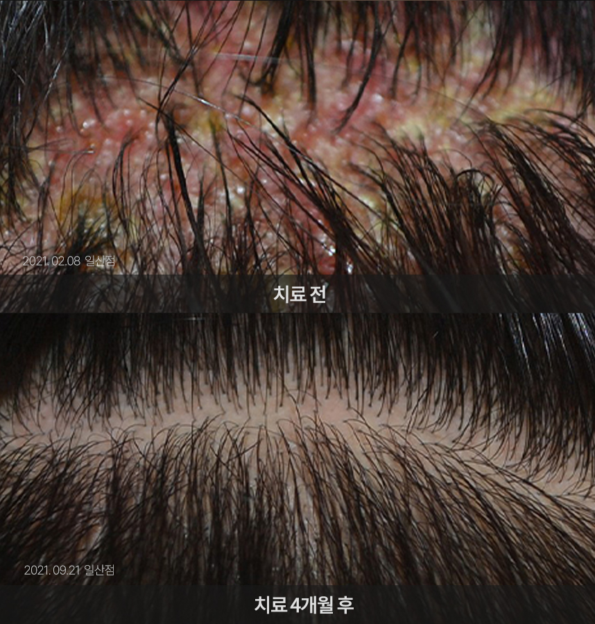 지루성두피염 치료 전후 사례