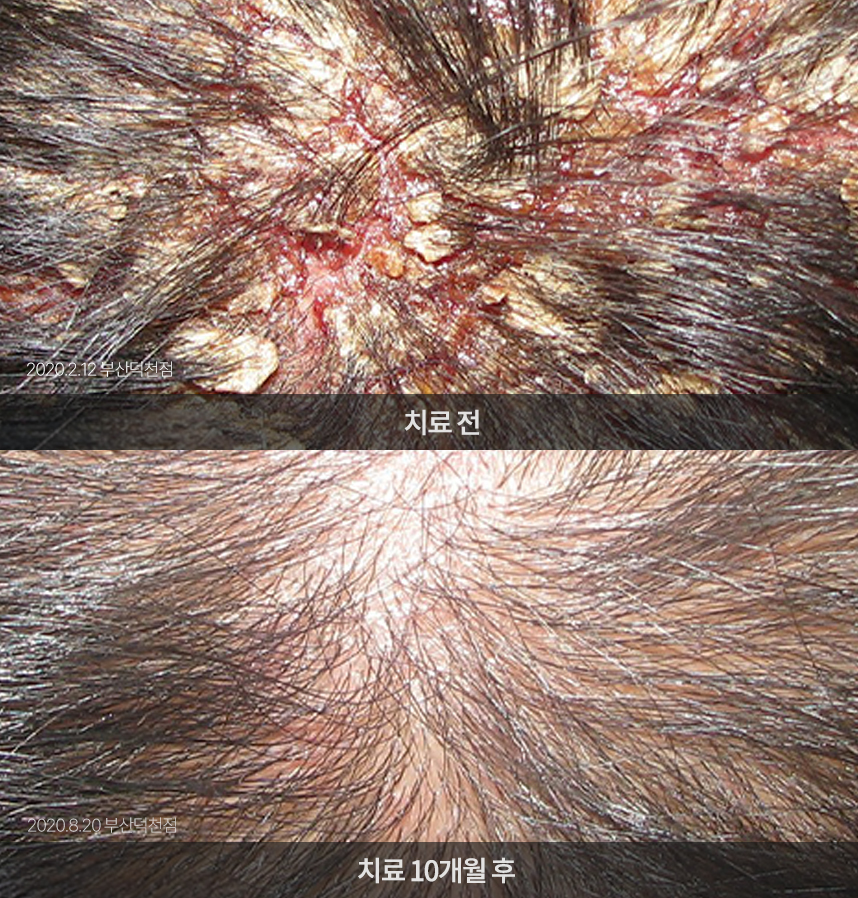 지루성두피염 치료 전후 사례