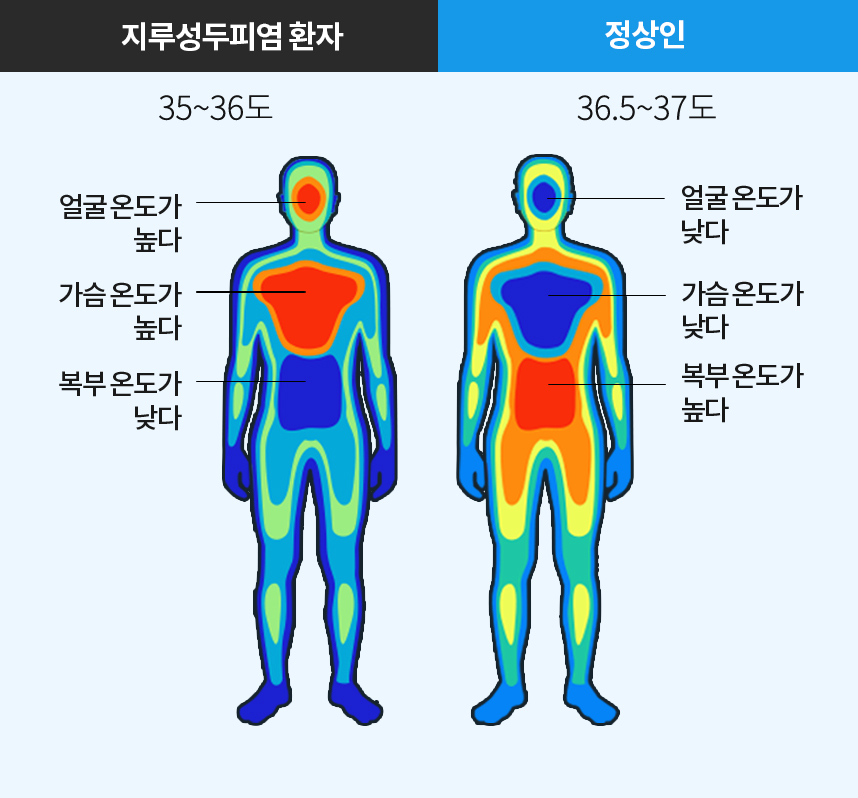 지루성두피염환자 체온