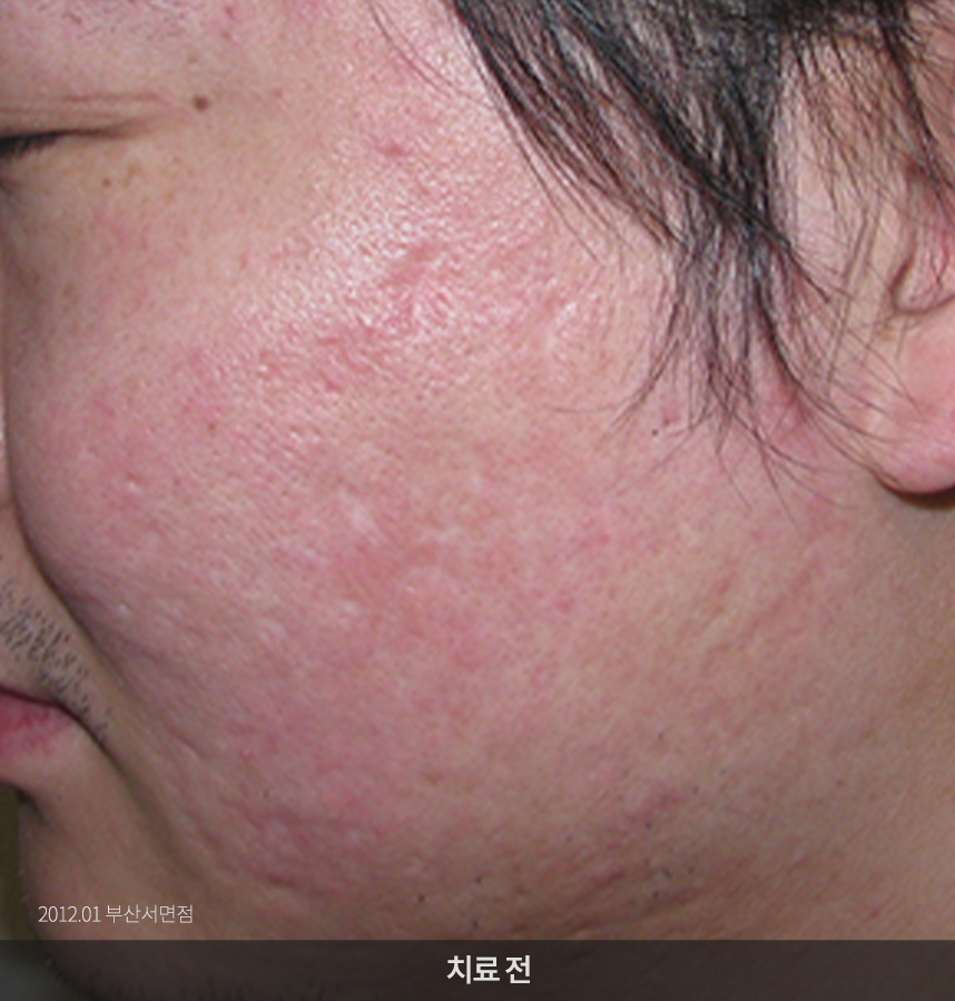 지루성피부염 치료전