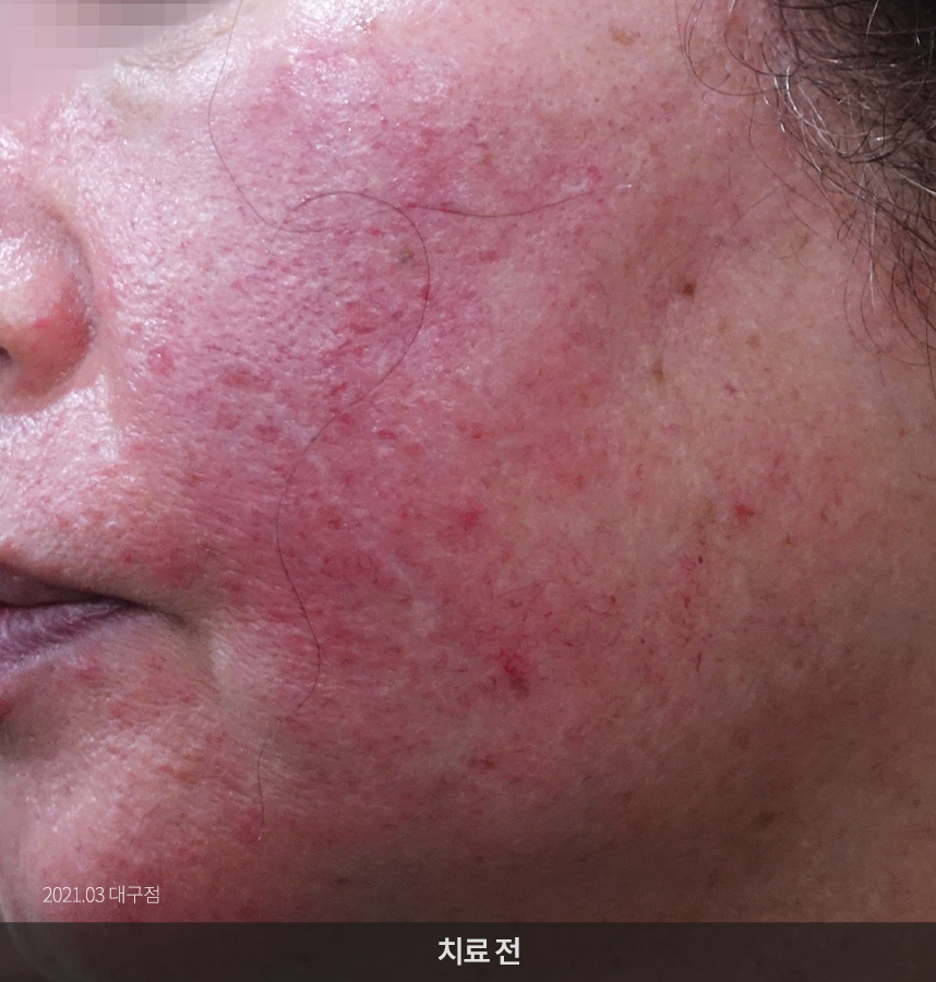 지루성피부염 치료전