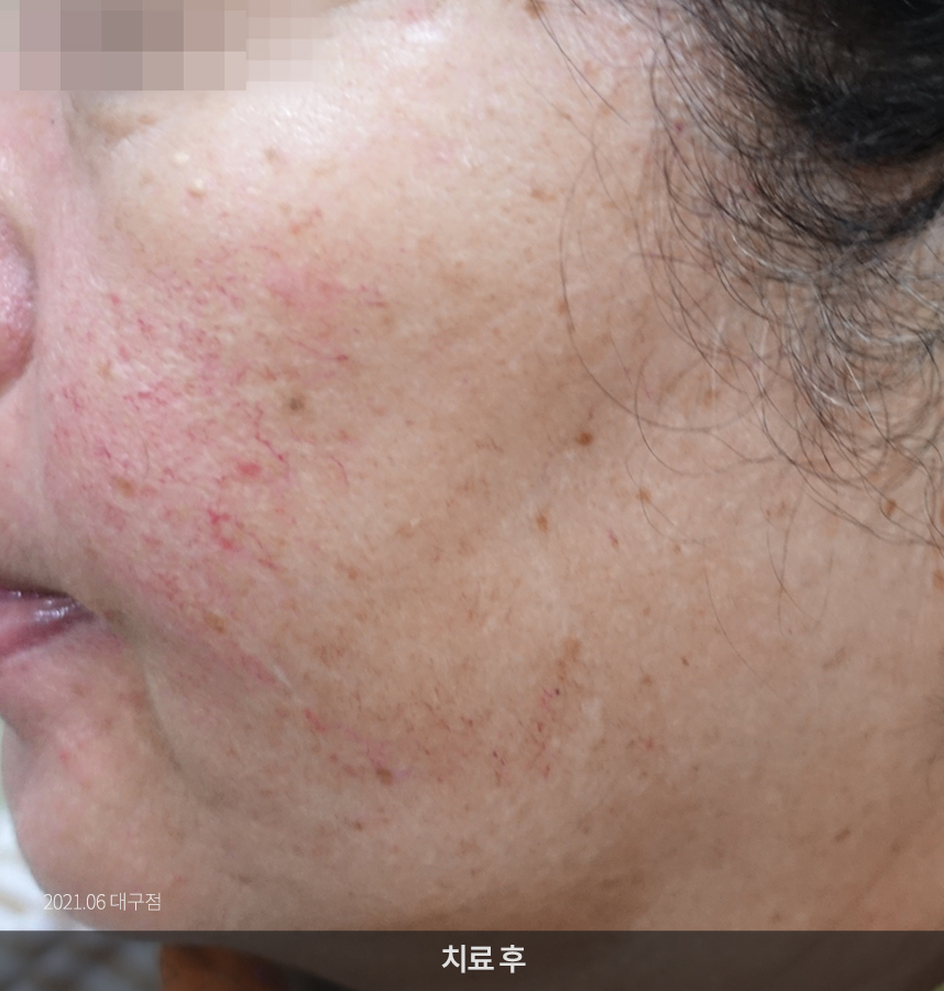 지루성피부염 치료후