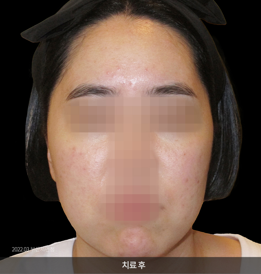 지루성피부염 치료후