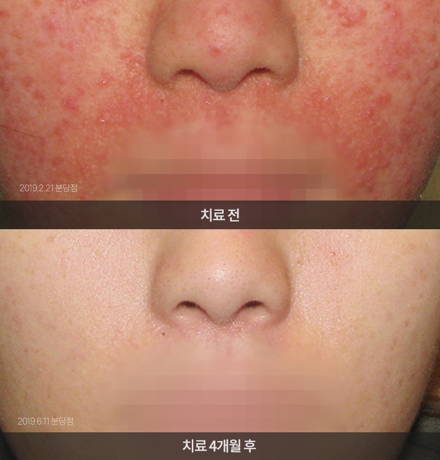 지루성피부염 치료 전후 사례