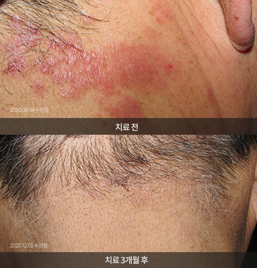 지루성피부염 치료 전후 사례