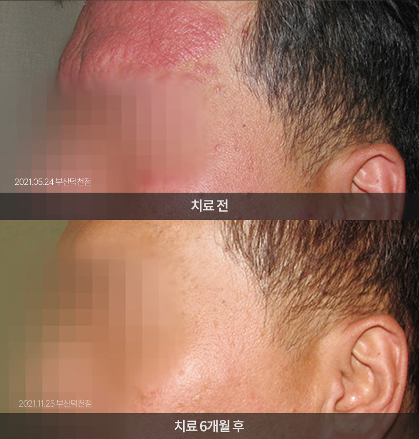 지루성피부염 치료 전후 사례