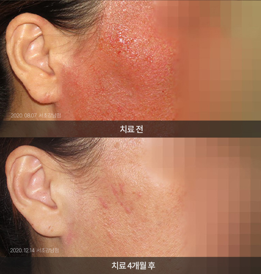 지루성피부염 치료 전후 사례