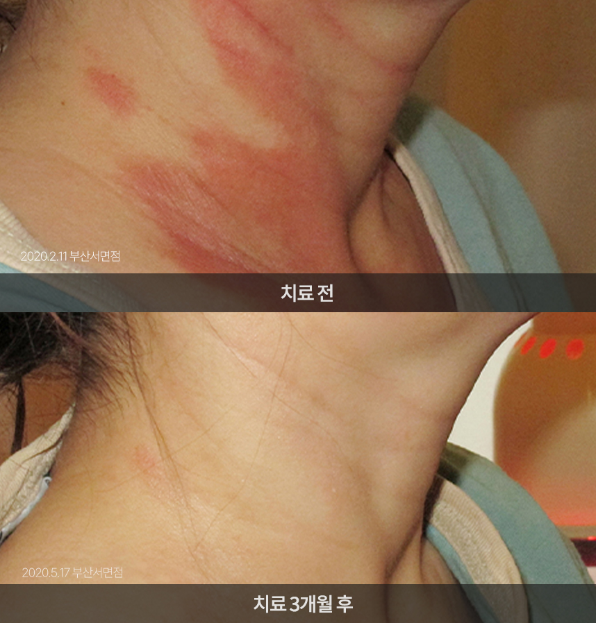 지루성피부염 치료 전후 사례