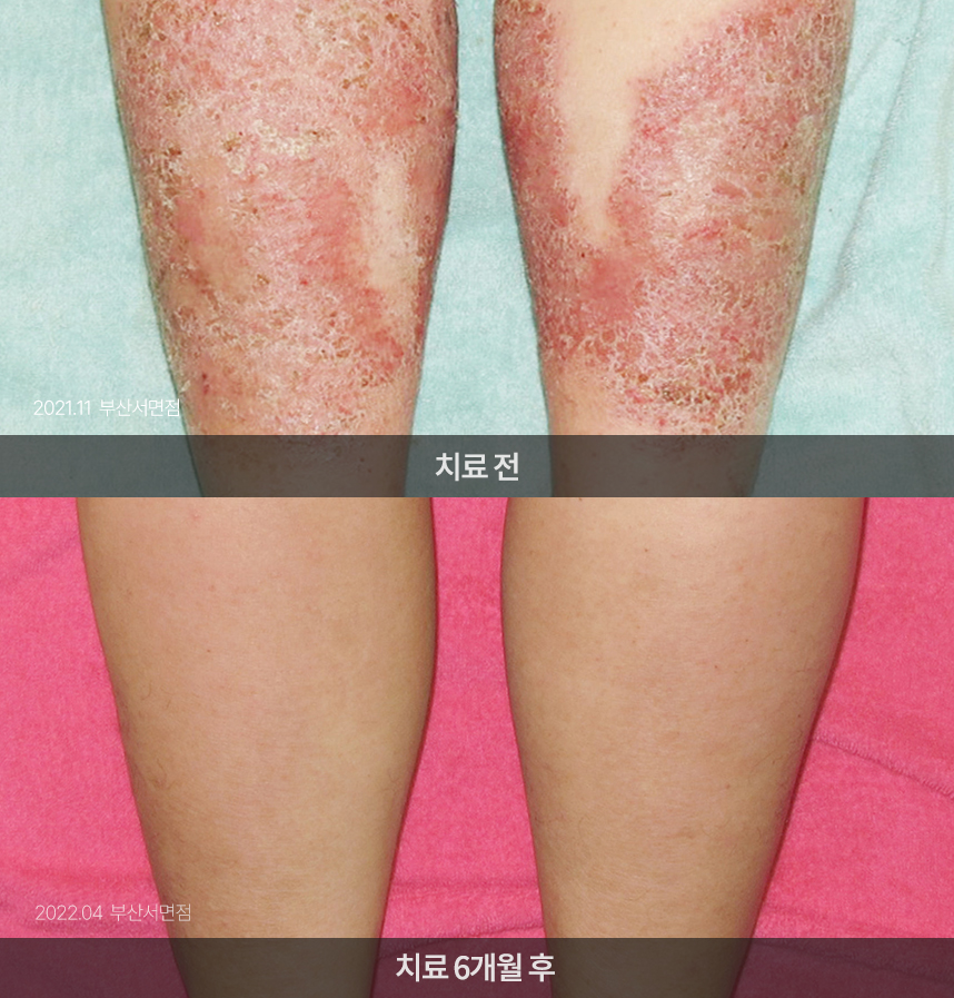 화폐상 습진 치료 전후 사례