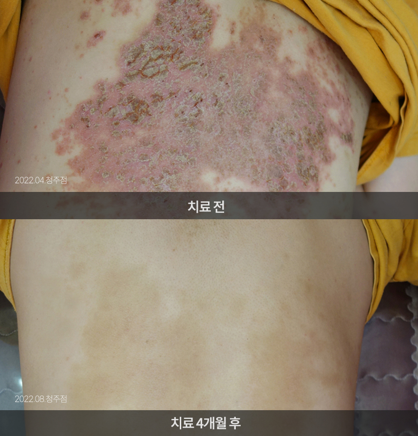 화폐상 습진 치료 전후 사례