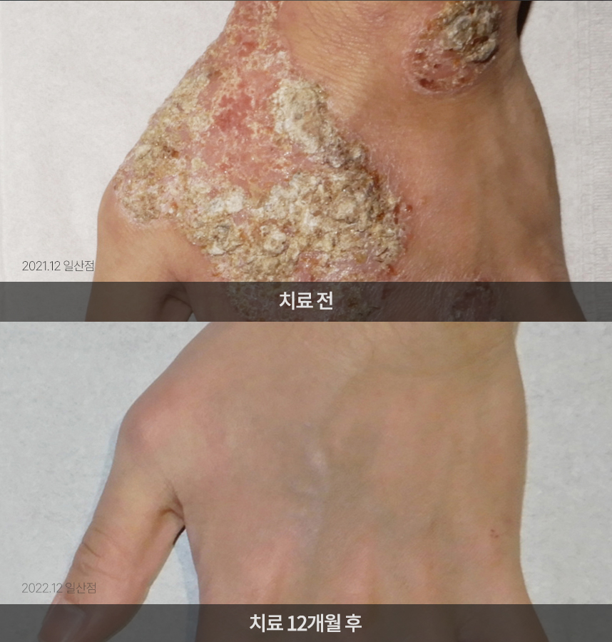화폐상 습진 치료 전후 사례