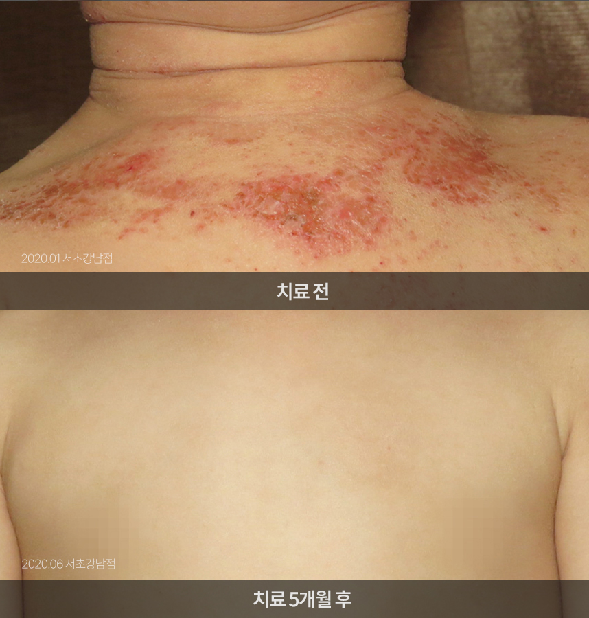 화폐상 습진 치료 전후 사례