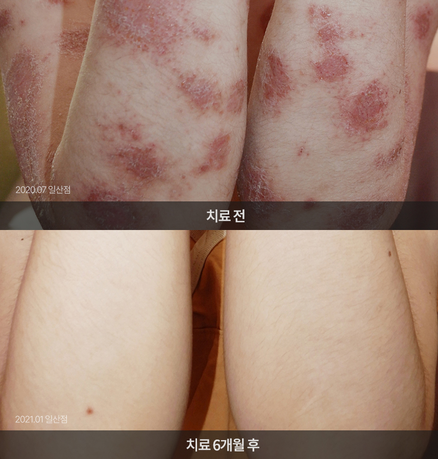 화폐상 습진 치료 전후 사례