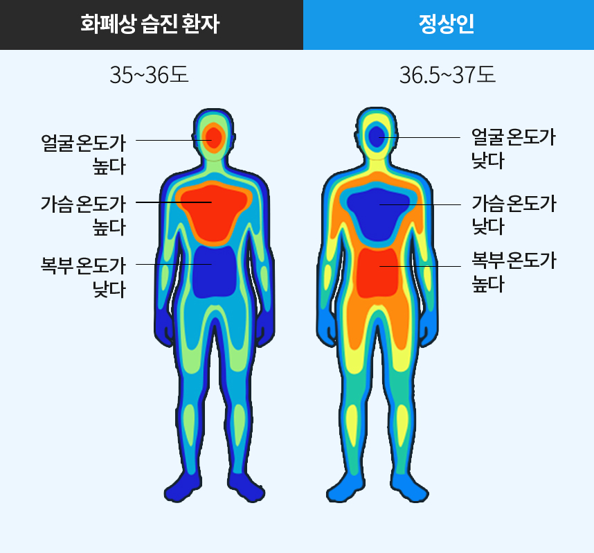 화폐상 습진환자 체온